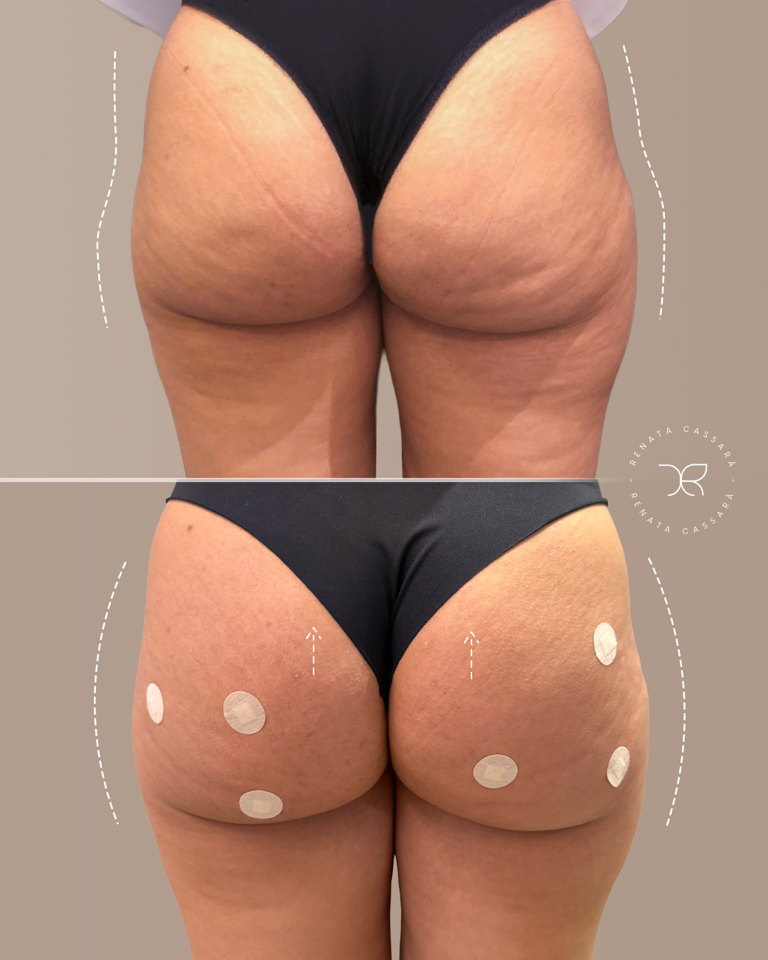 Resultado Glúteos 3D - Tratamento completo