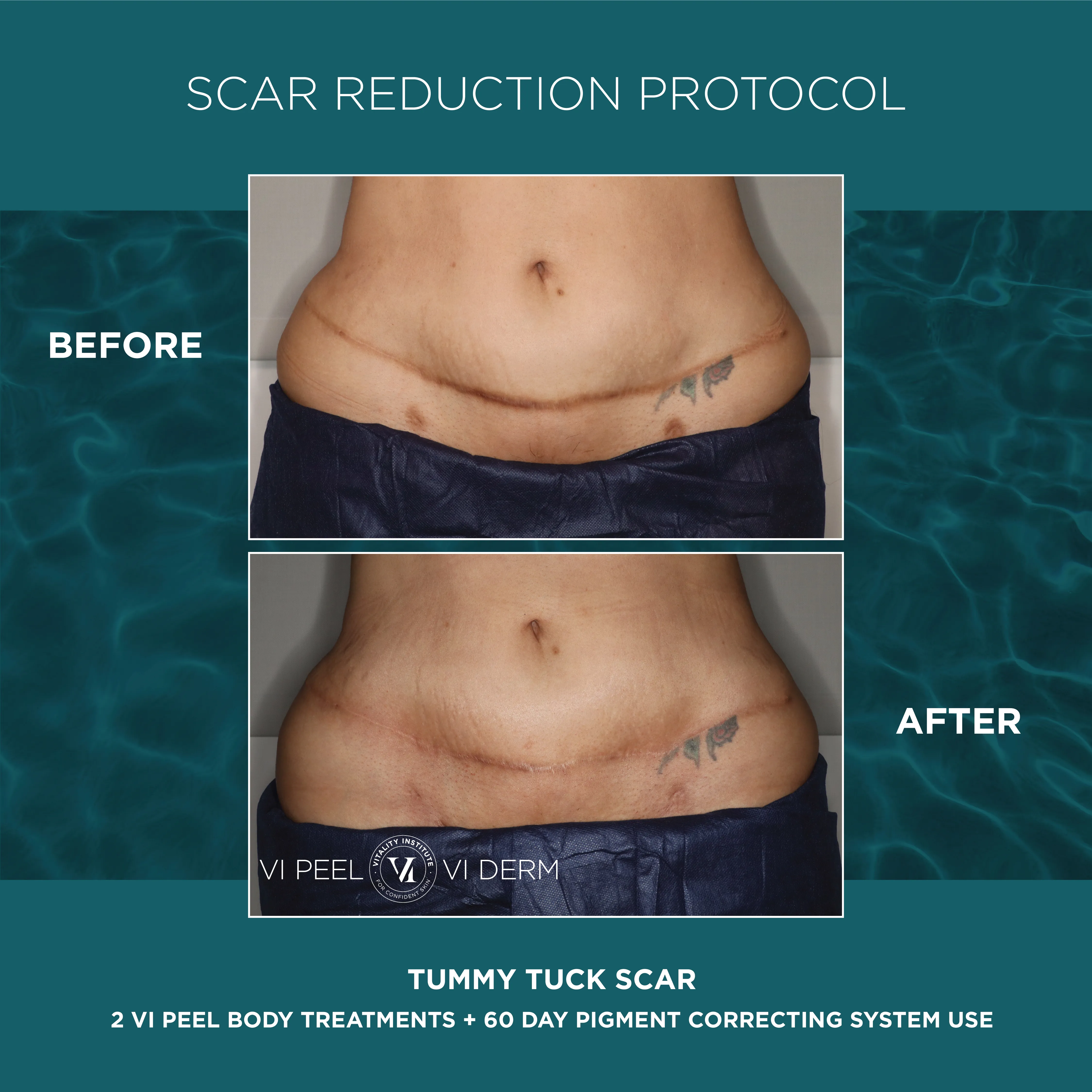 Tummy Tuck Scar — 2 VI Peel Body + 60 Day Pigment Correcting System