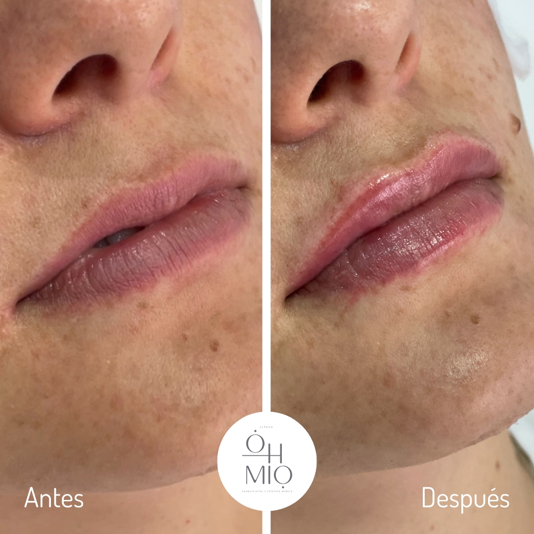 Resultado de diseño de labios con ácido hialurónico, antes y después, en Clínica Ohmio