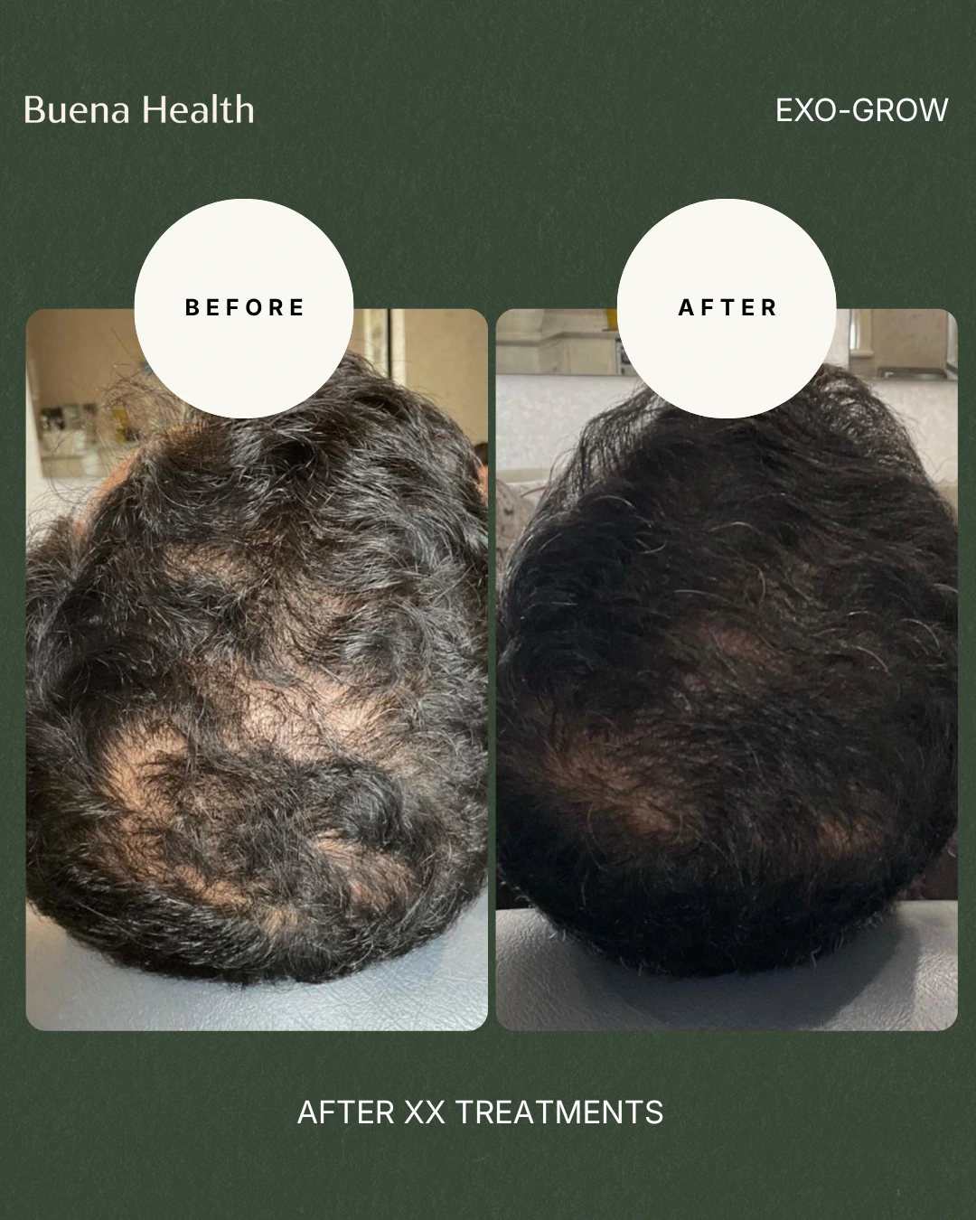 ExO-Grow scalp treatment before and after result showing improved crown coverage