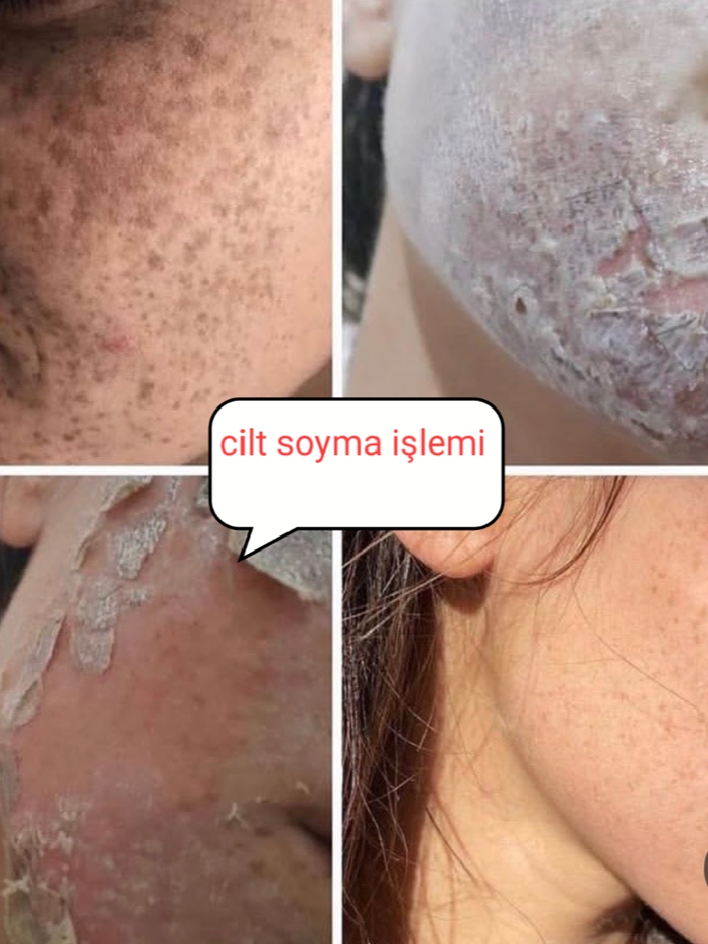 Skin Care & Acne Treatment — Before & After 5