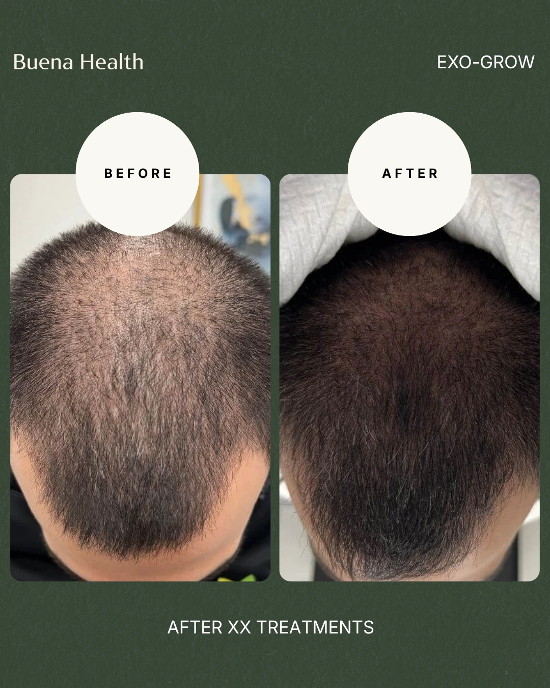 ExO-Grow scalp treatment before and after result showing improved hairline density