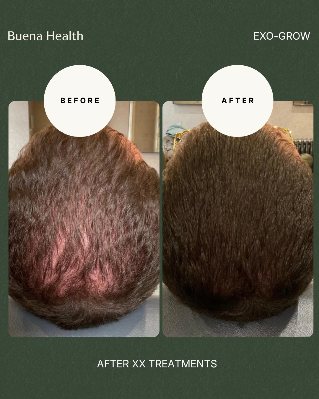 ExO-Grow scalp treatment before and after result showing improved crown density
