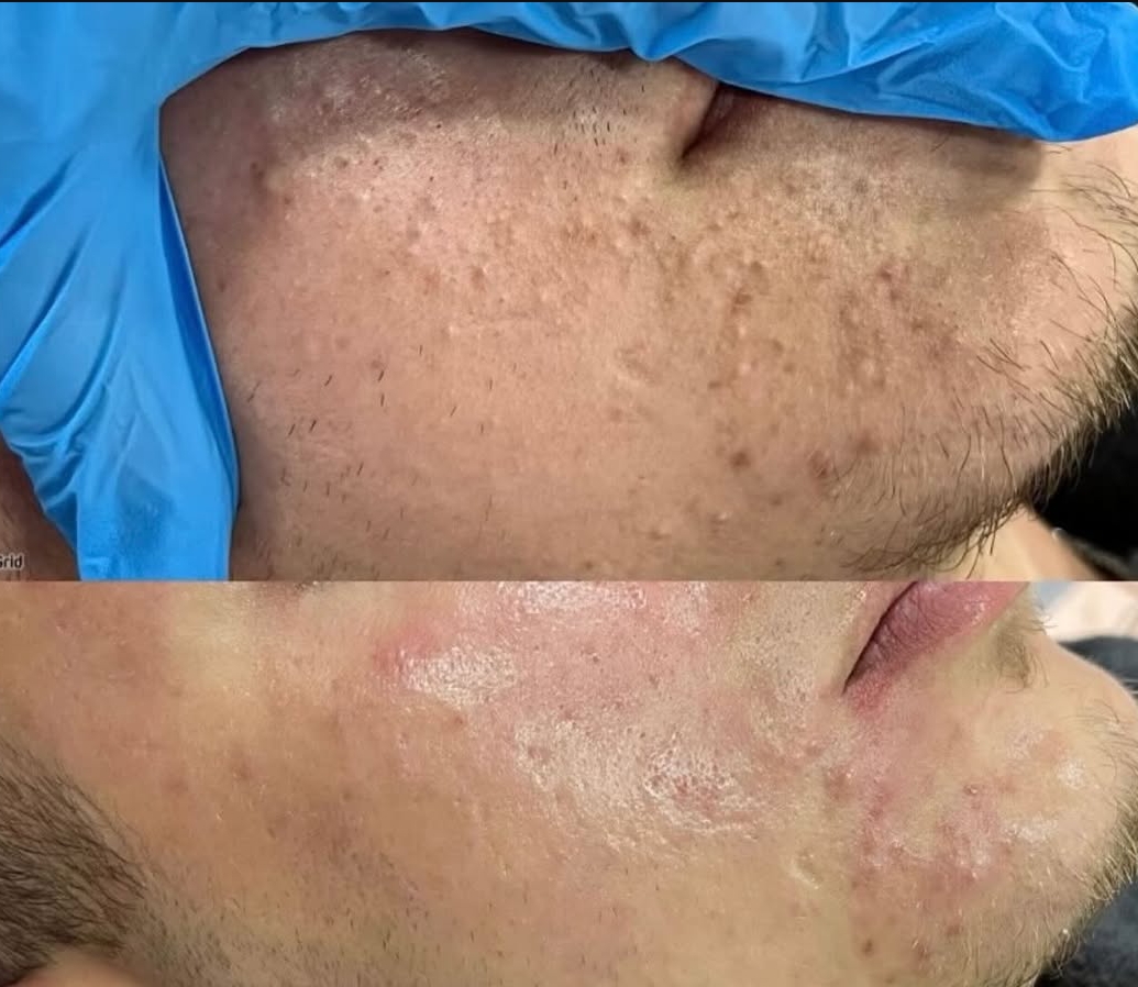 Skin Care & Acne Treatment — Before & After 6