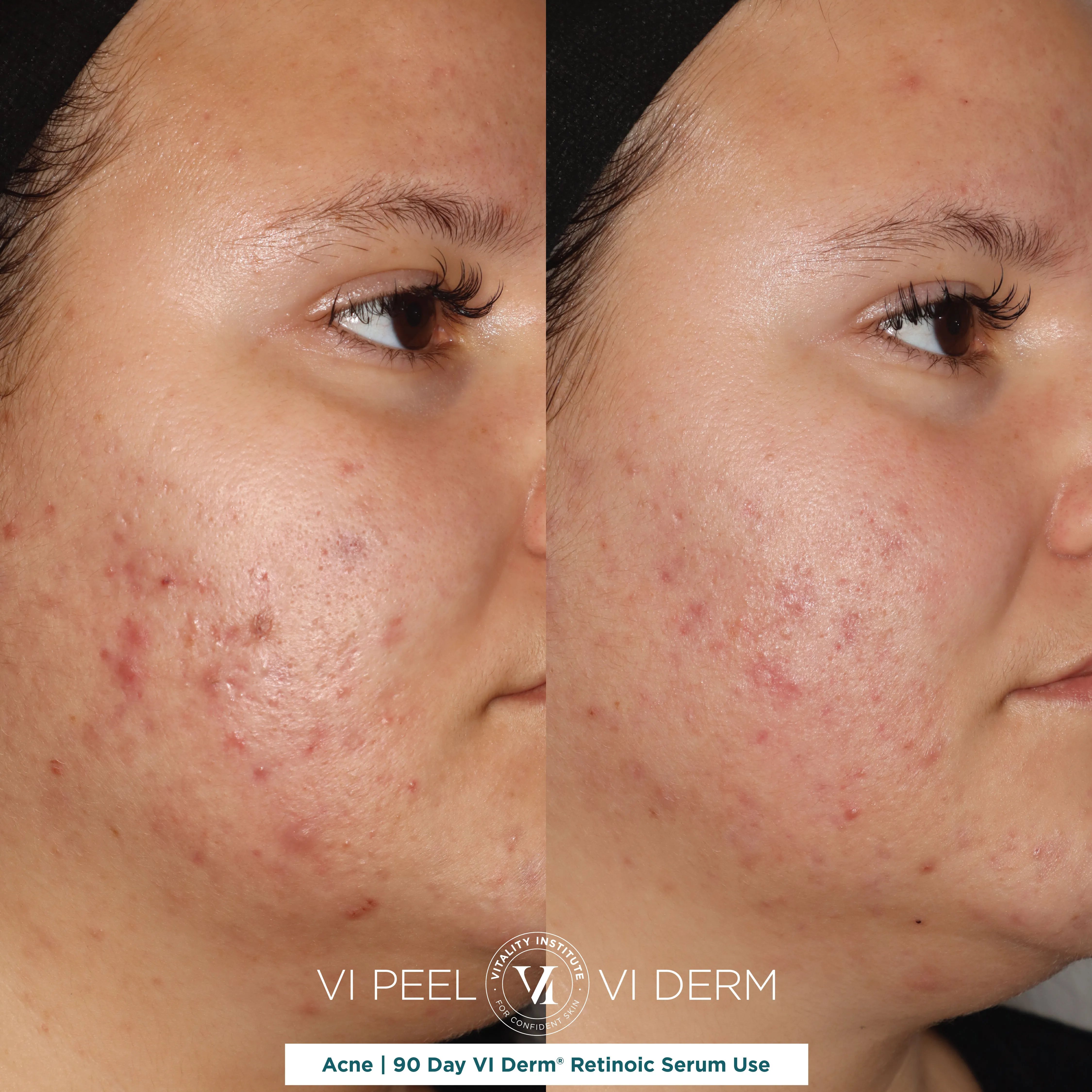 Acne — VI Derm Retinoic Serum, 90 Day Use