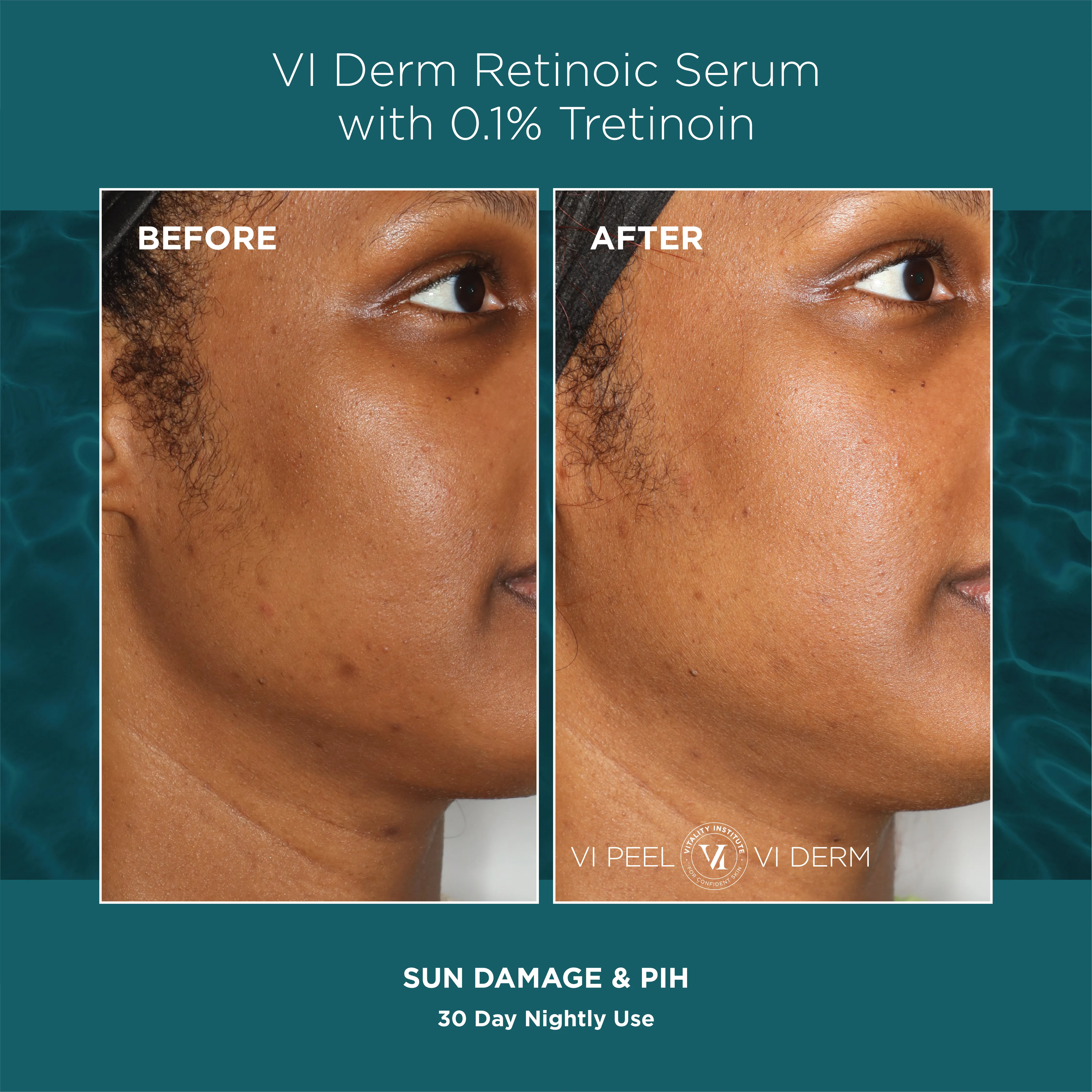 Sun Damage & PIH — VI Derm Retinoic Serum 0.1% Tretinoin, 30 Days