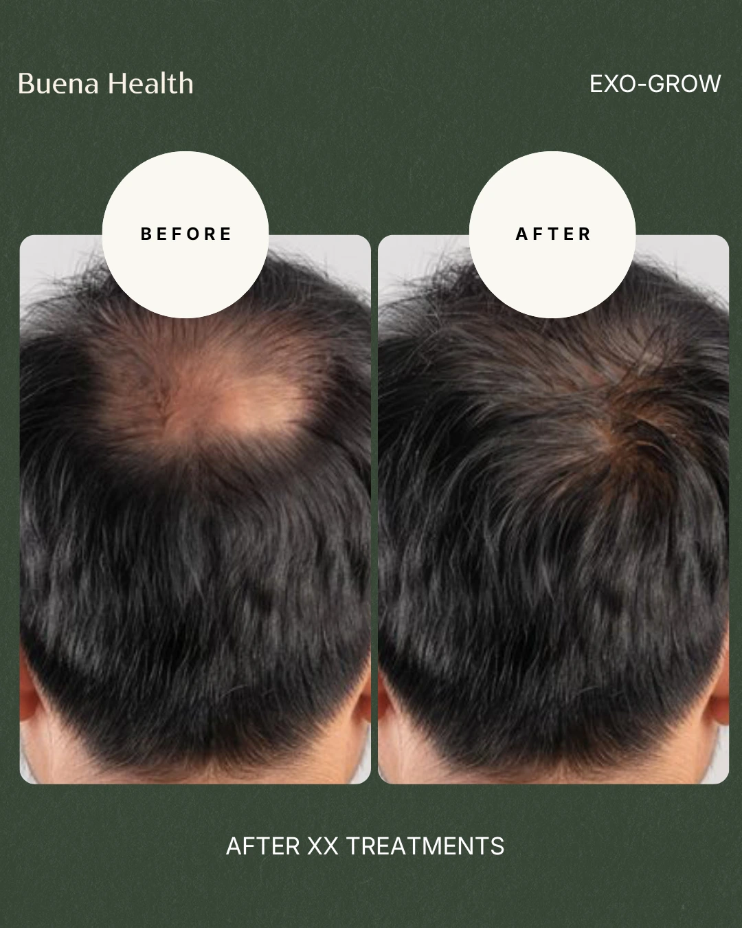 ExO-Grow scalp treatment before and after result showing improved crown density