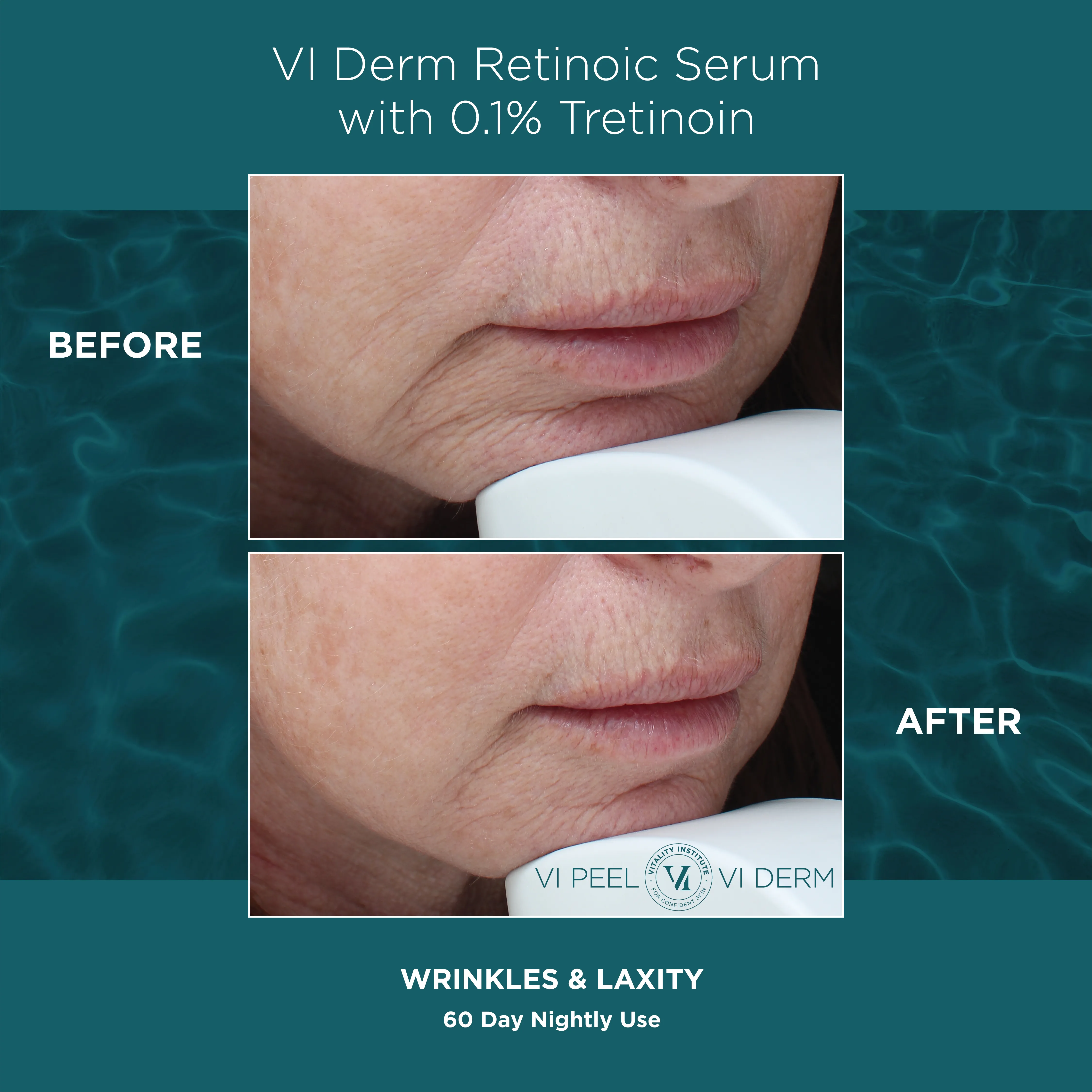 Wrinkles & Laxity — VI Derm Retinoic Serum 0.1% Tretinoin, 60 Days