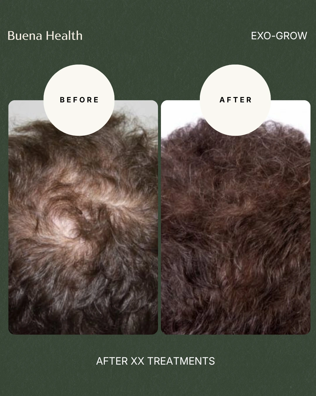 ExO-Grow scalp treatment before and after result showing improved scalp coverage