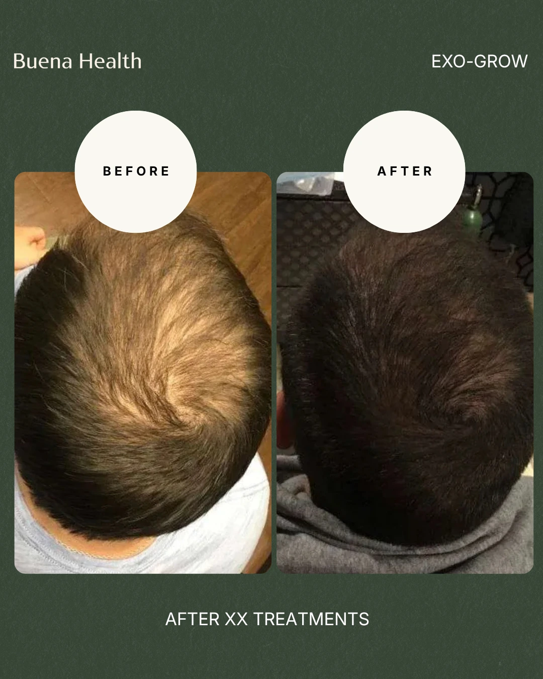 ExO-Grow scalp treatment before and after result showing fuller crown coverage