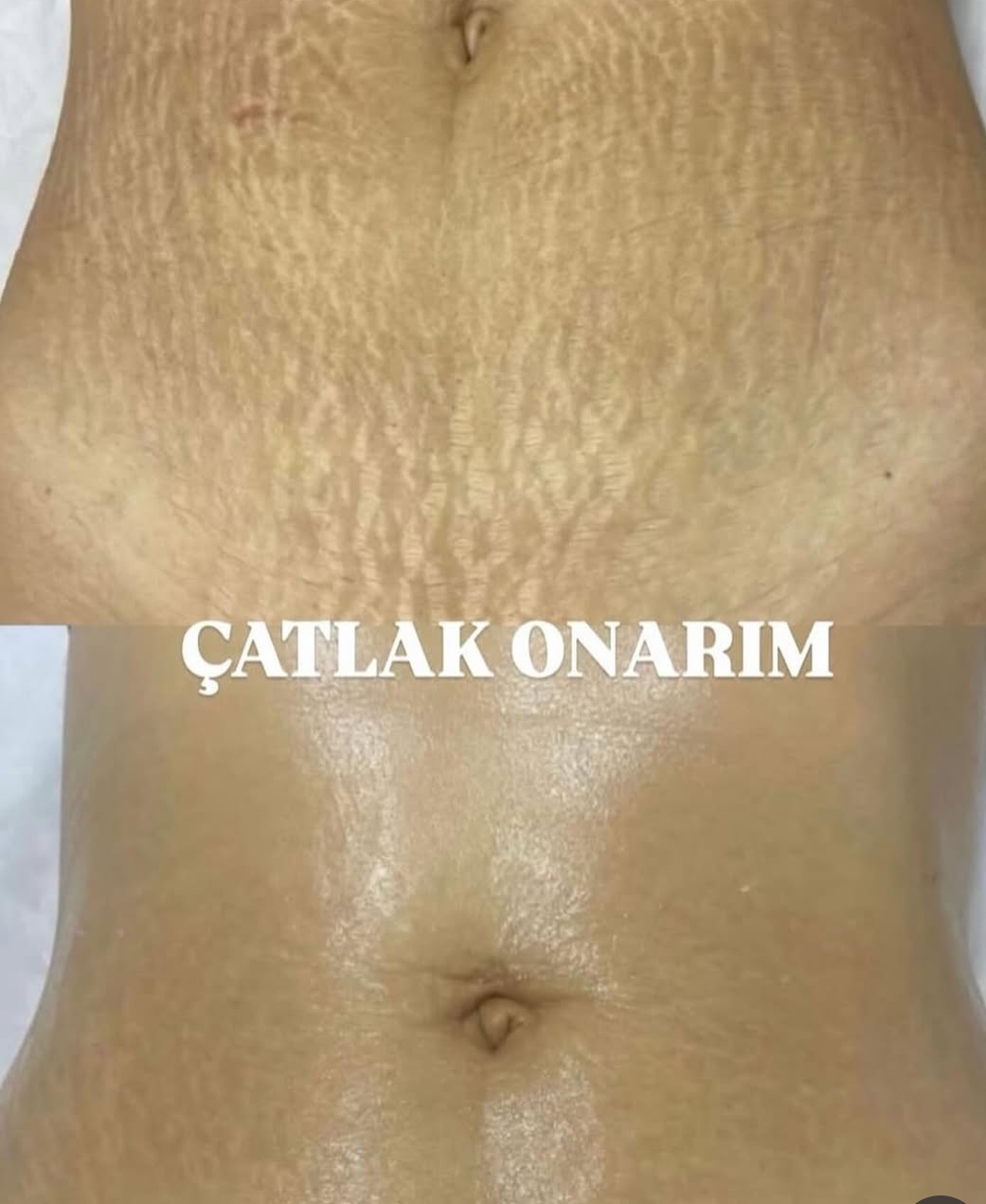 Stretch Mark Treatment — Before & After 1