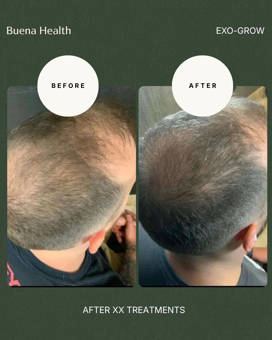 ExO-Grow scalp treatment before and after result showing thicker hair