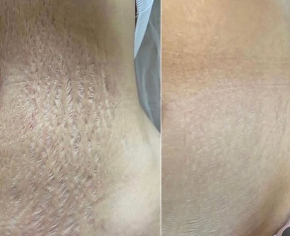 Stretch Mark Treatment — Before & After 2