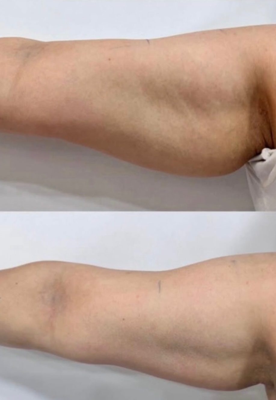 Dipotens Body Firming — Before & After 2