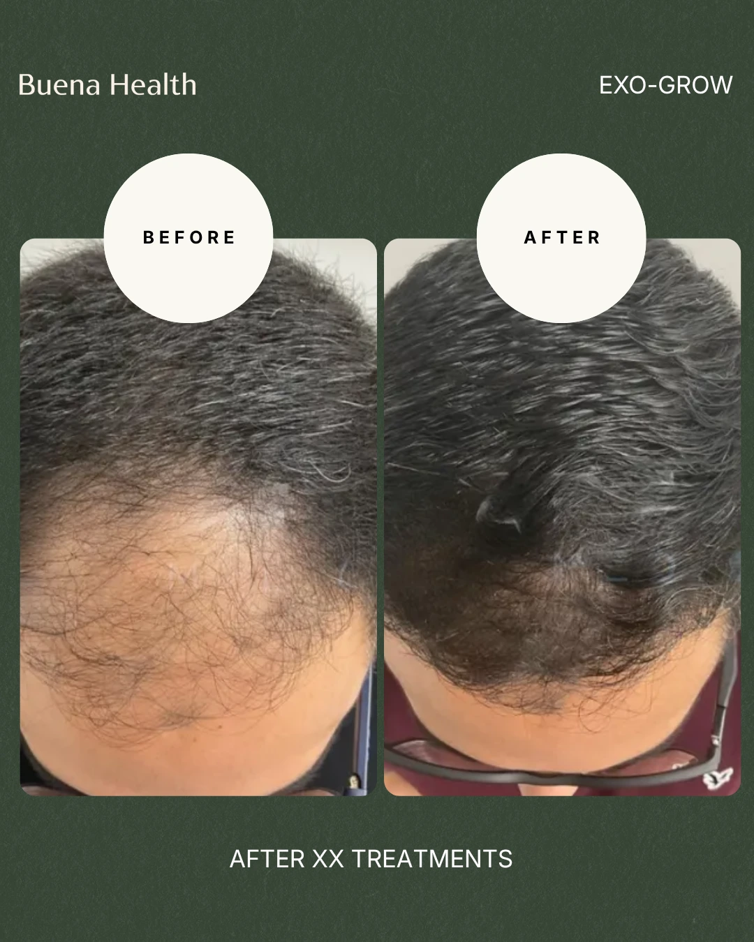 ExO-Grow scalp treatment before and after result showing fuller scalp coverage