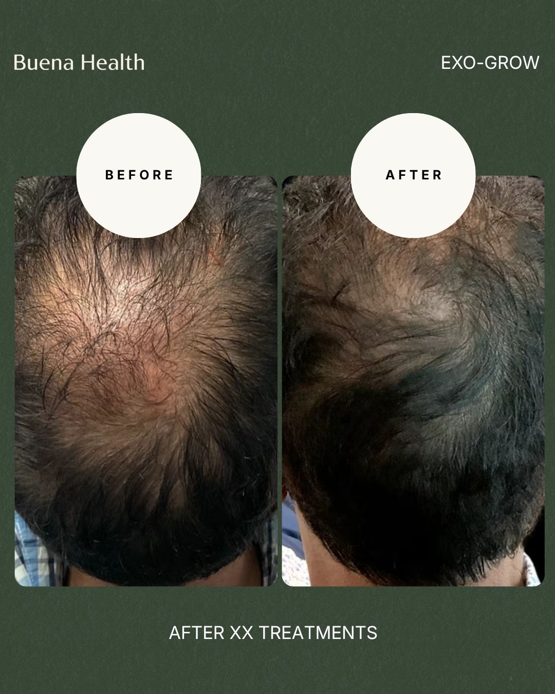 ExO-Grow scalp treatment before and after result showing improved hair density