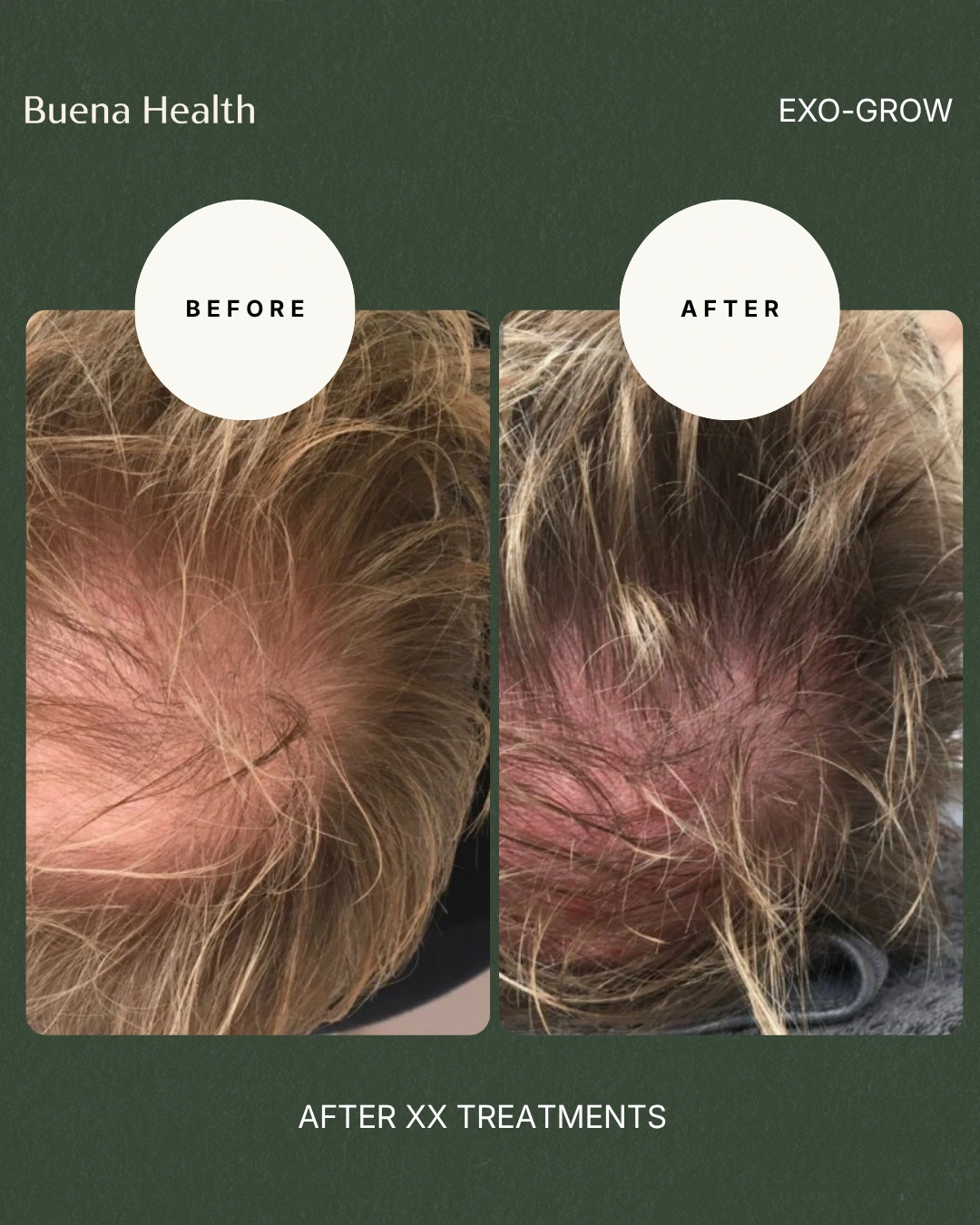 ExO-Grow scalp treatment before and after result showing increased density