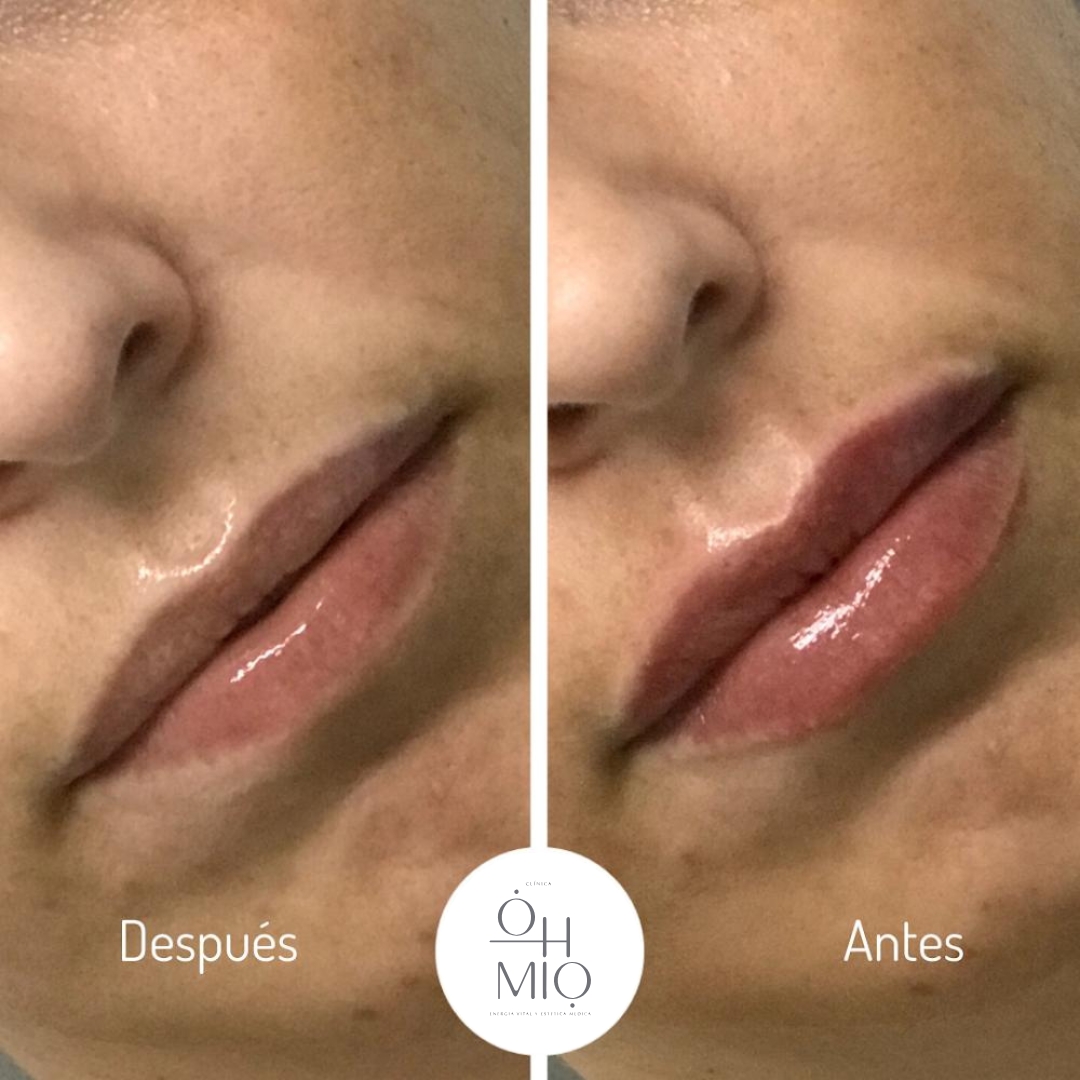 Antes y después de diseño de labios con ácido hialurónico, caso 2
