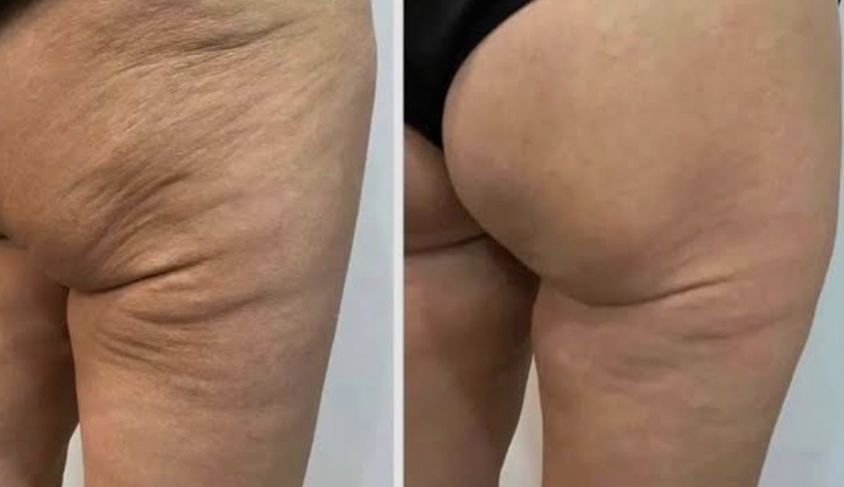 G9 Body Contouring & Cellulite — Before & After 2