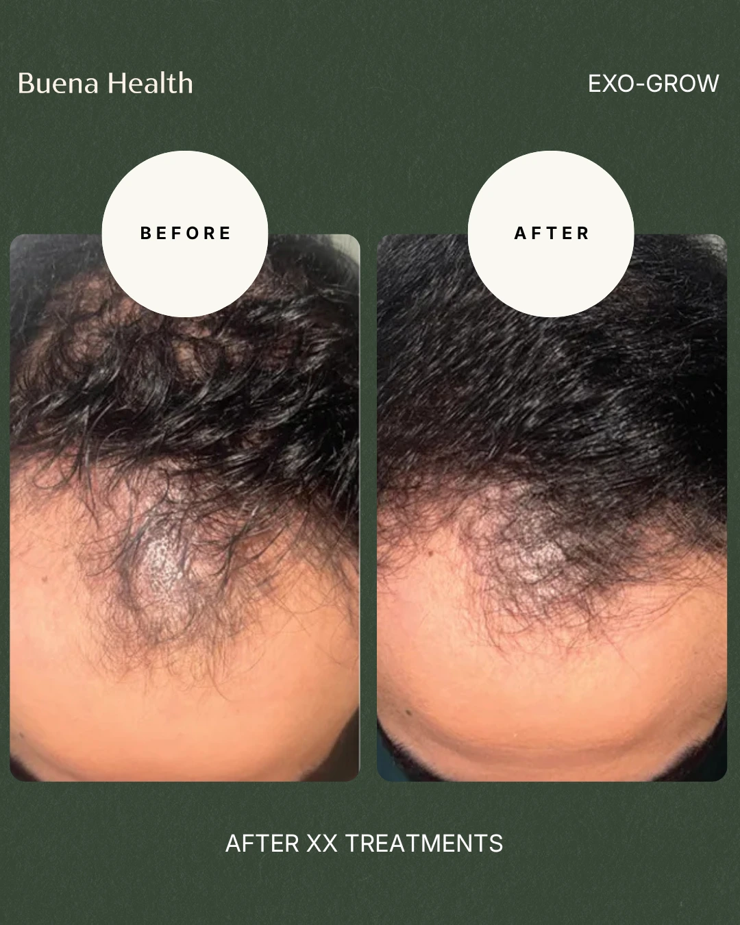 ExO-Grow scalp treatment before and after result showing increased crown density