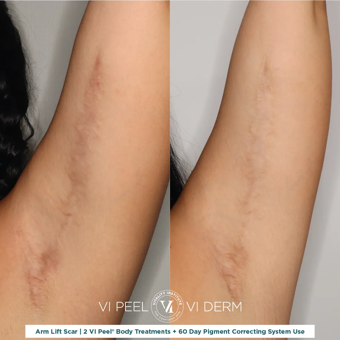 Arm Lift Scar (Left) — 2 VI Peel Body + 60 Day Pigment Correcting System