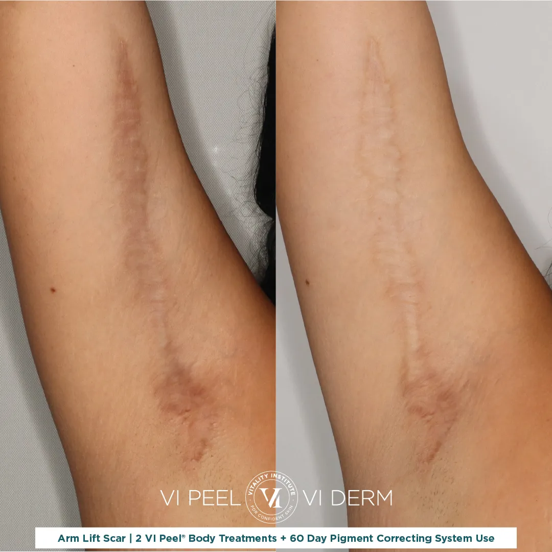 Arm Lift Scar (Right) — 2 VI Peel Body + 60 Day Pigment Correcting System