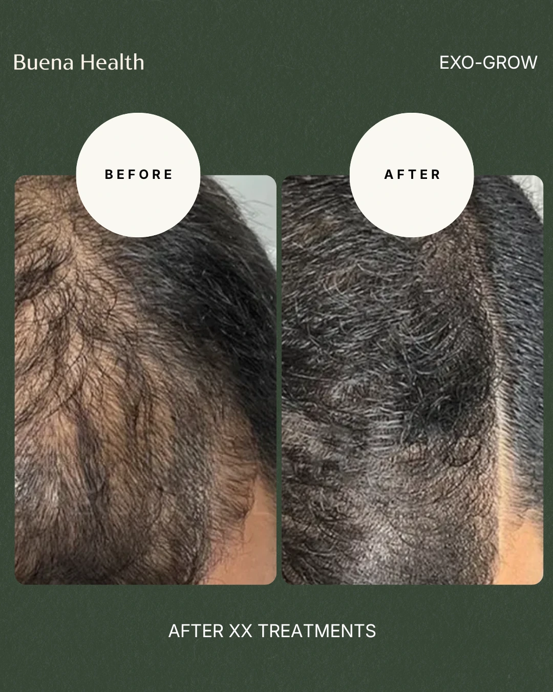 ExO-Grow scalp treatment before and after result showing improved temple density