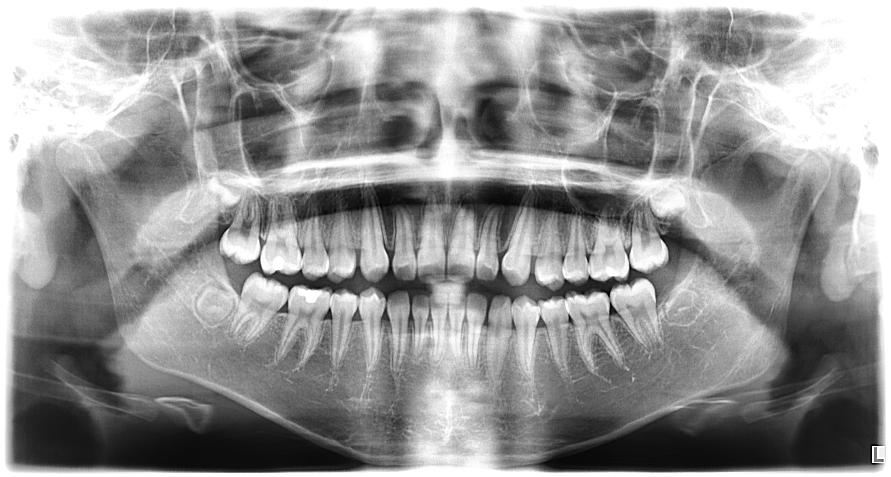 Panoramic X-Ray example 1