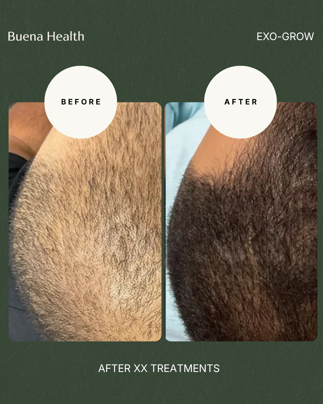 ExO-Grow scalp treatment before and after result showing improved hairline density