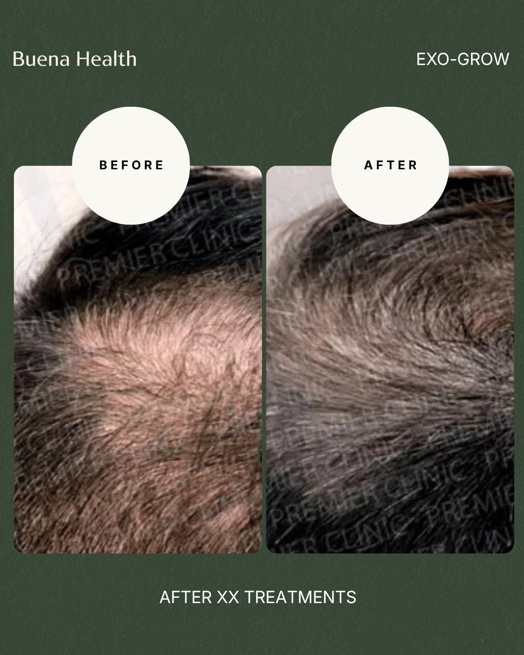 ExO-Grow scalp treatment before and after result showing improved scalp density