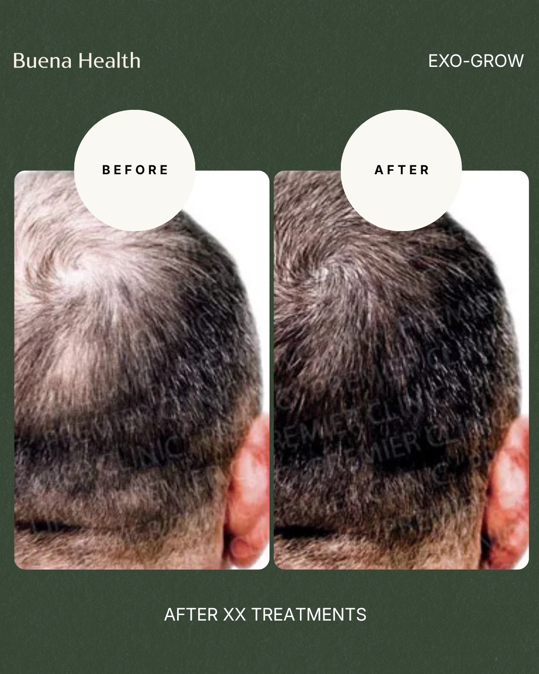 ExO-Grow scalp treatment before and after result showing improved hair density