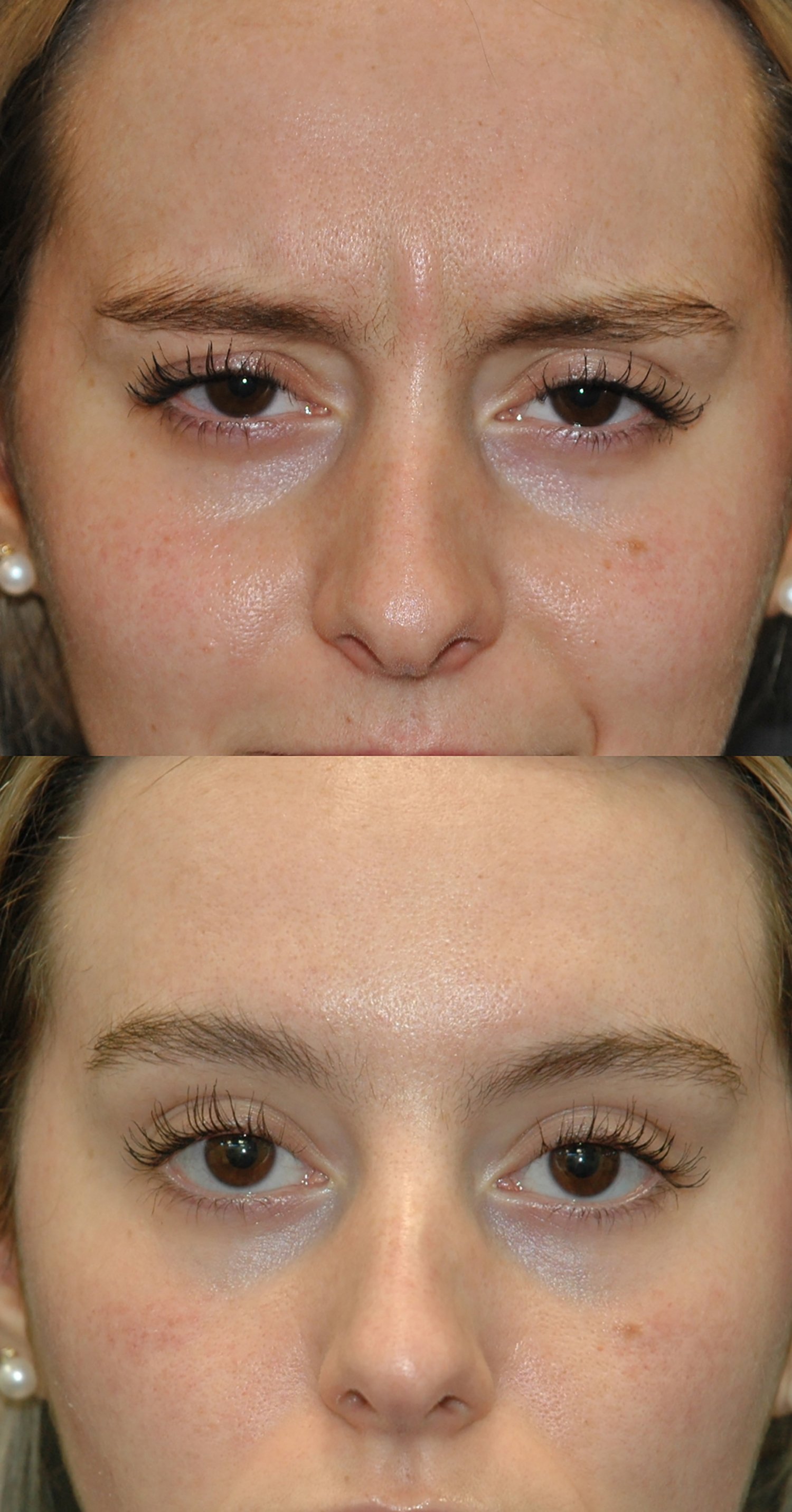 Botox before and after photographs, case 1, with the before photograph on top and the after photograph below