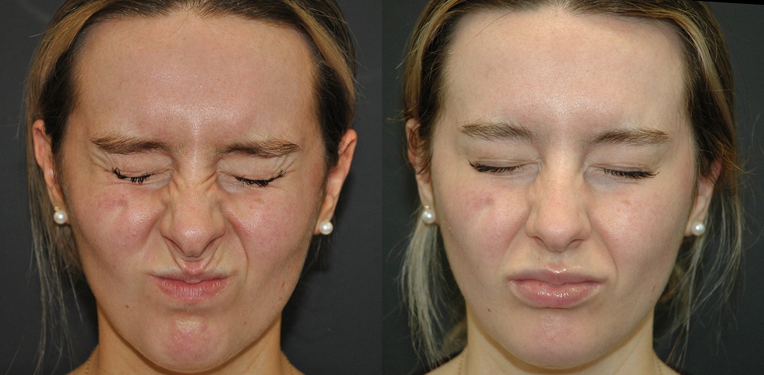 Botox before and after photographs, case 3, with the before photograph on the left and the after photograph on the right