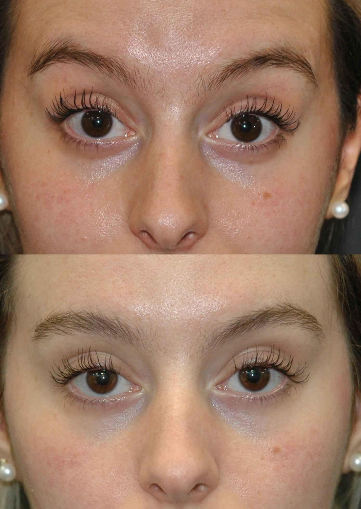 Botox before and after photographs, case 2, with the before photograph on top and the after photograph below
