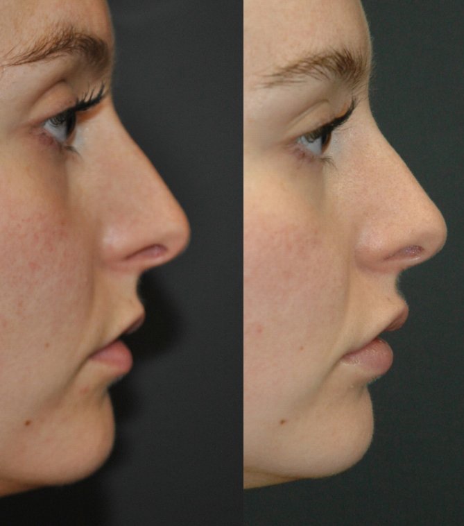 Juvederm lip filler before and after photographs, case 3, with the before photograph on the left and the after photograph on the right