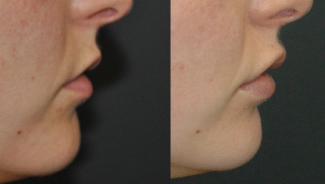 Juvederm lip filler before and after photographs, case 4, with the before photograph on the left and the after photograph on the right