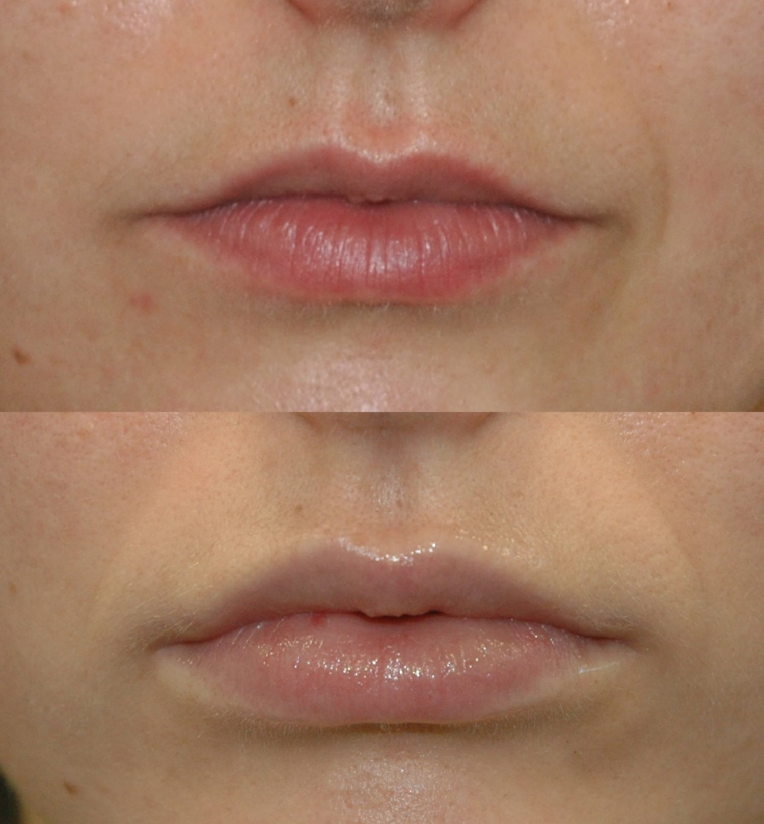 Juvederm lip filler before and after photographs, case 1, with the before photograph on top and the after photograph below