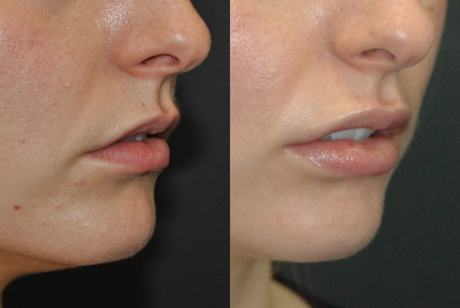 Juvederm lip filler before and after photographs, case 2, with the before photograph on the left and the after photograph on the right