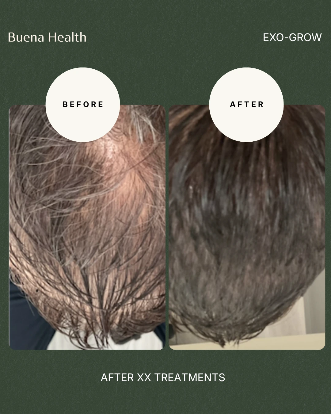 ExO-Grow scalp treatment before and after result showing improved crown density