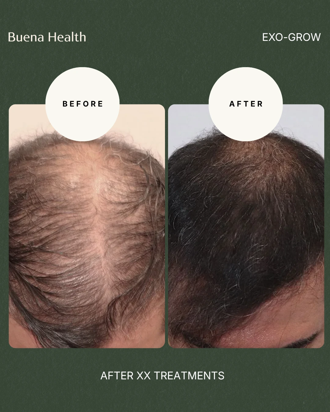 ExO-Grow scalp treatment before and after result showing fuller crown coverage