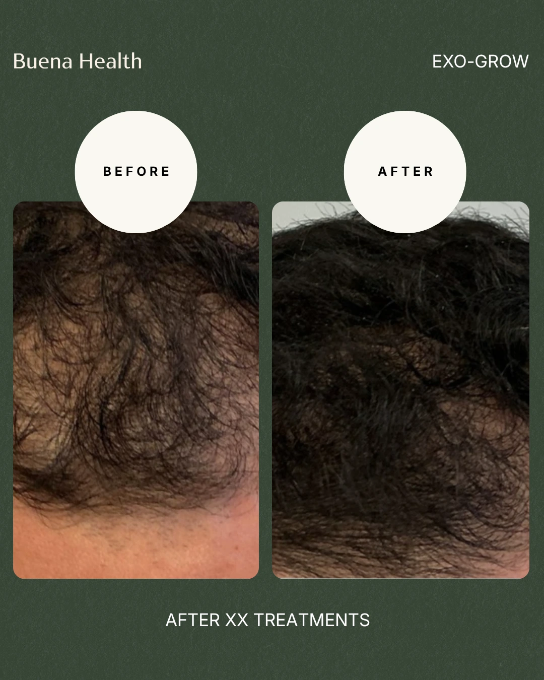 ExO-Grow scalp treatment before and after result showing improved scalp density