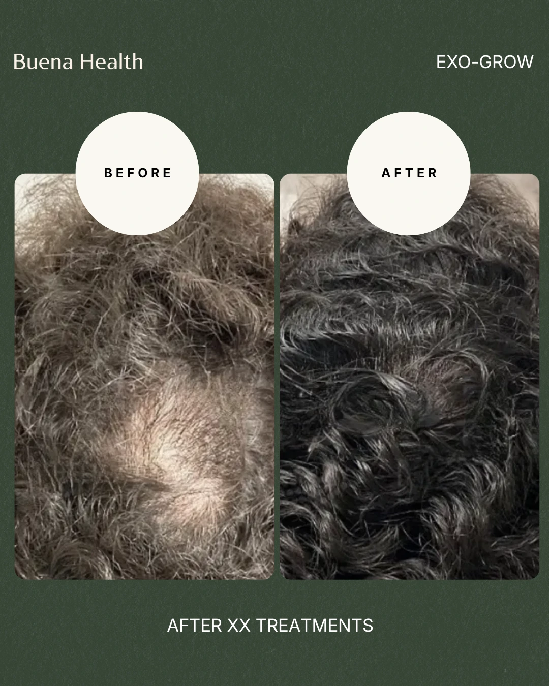 ExO-Grow scalp treatment before and after result showing improved crown density