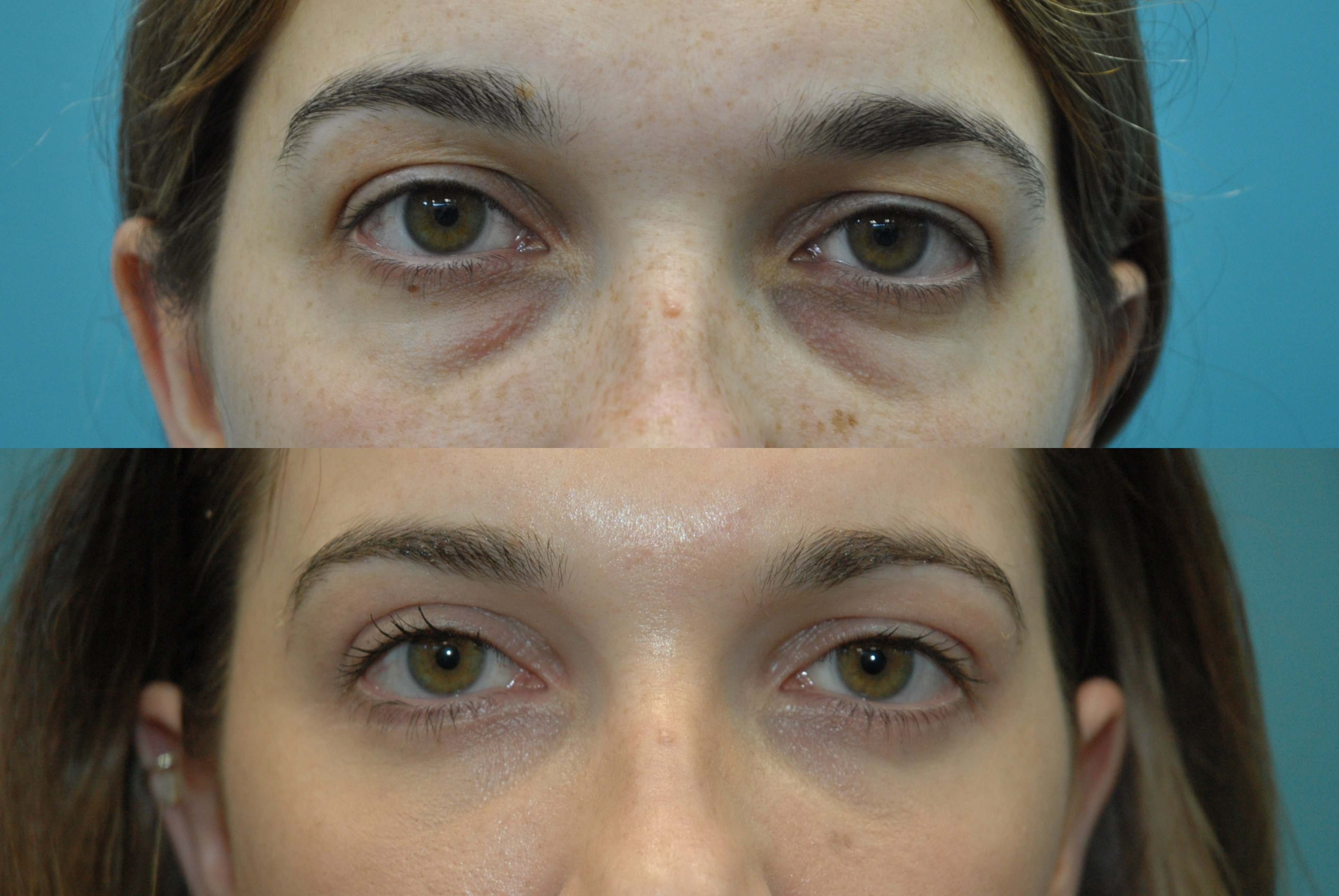 Blepharoplasty before and after photographs, case 2, with the before photograph on top and the after photograph below