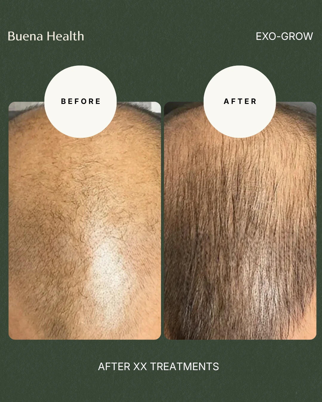 ExO-Grow scalp treatment before and after result showing fuller scalp coverage