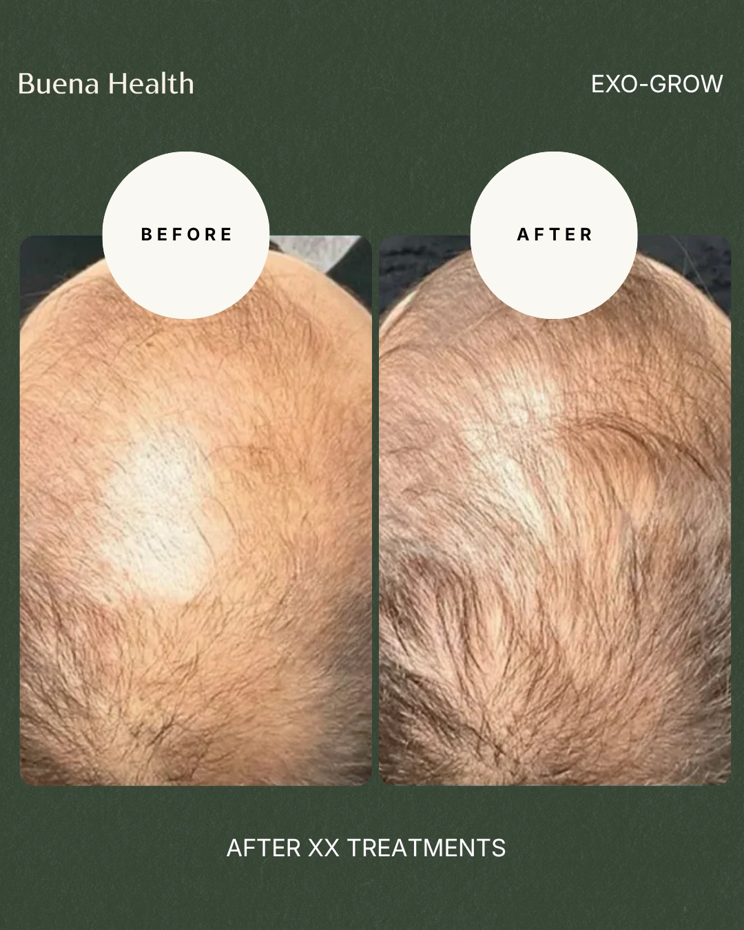 ExO-Grow scalp treatment before and after result showing fuller hair coverage