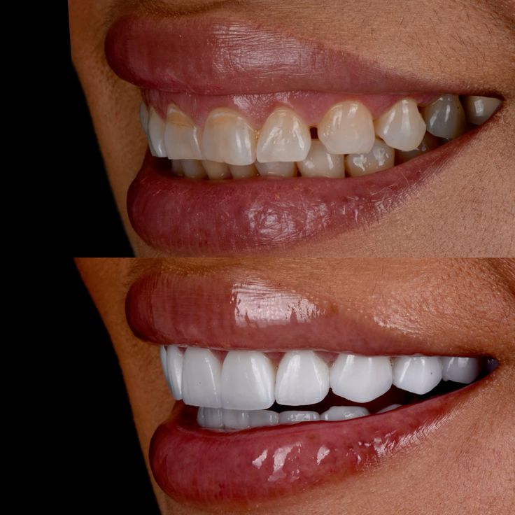 Before and after side profile smile transformation