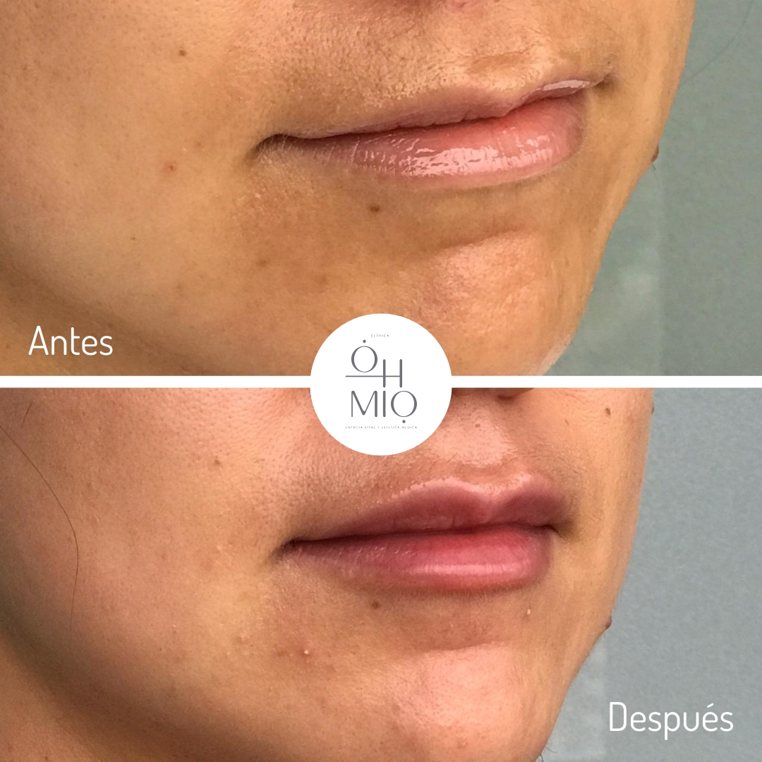 Antes y después de diseño de labios con ácido hialurónico, caso 4