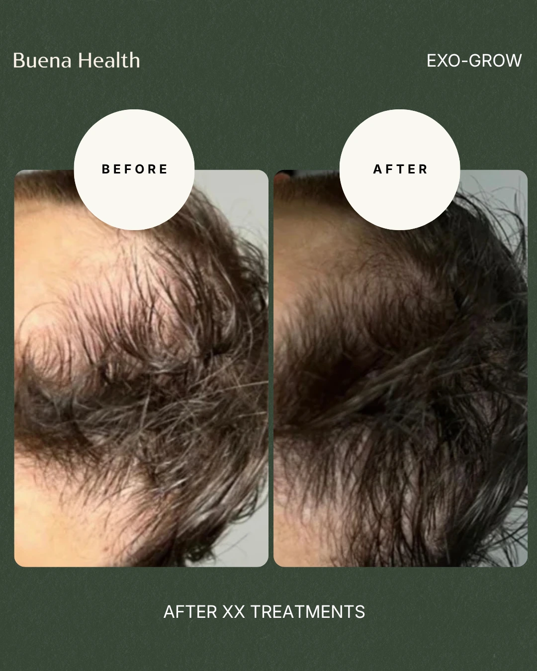 ExO-Grow scalp treatment before and after result showing fuller hair coverage