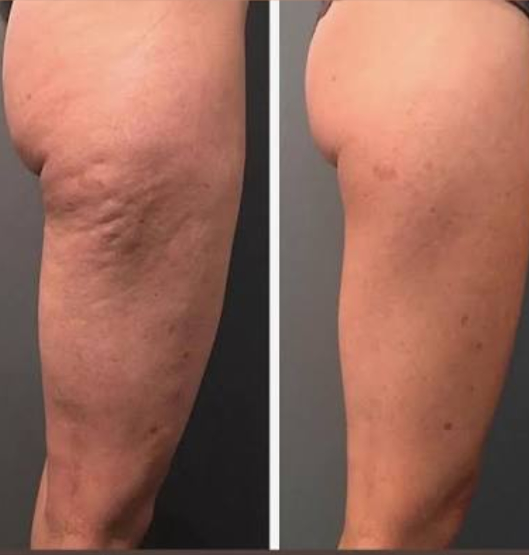 G9 Body Contouring & Cellulite — Before & After 3