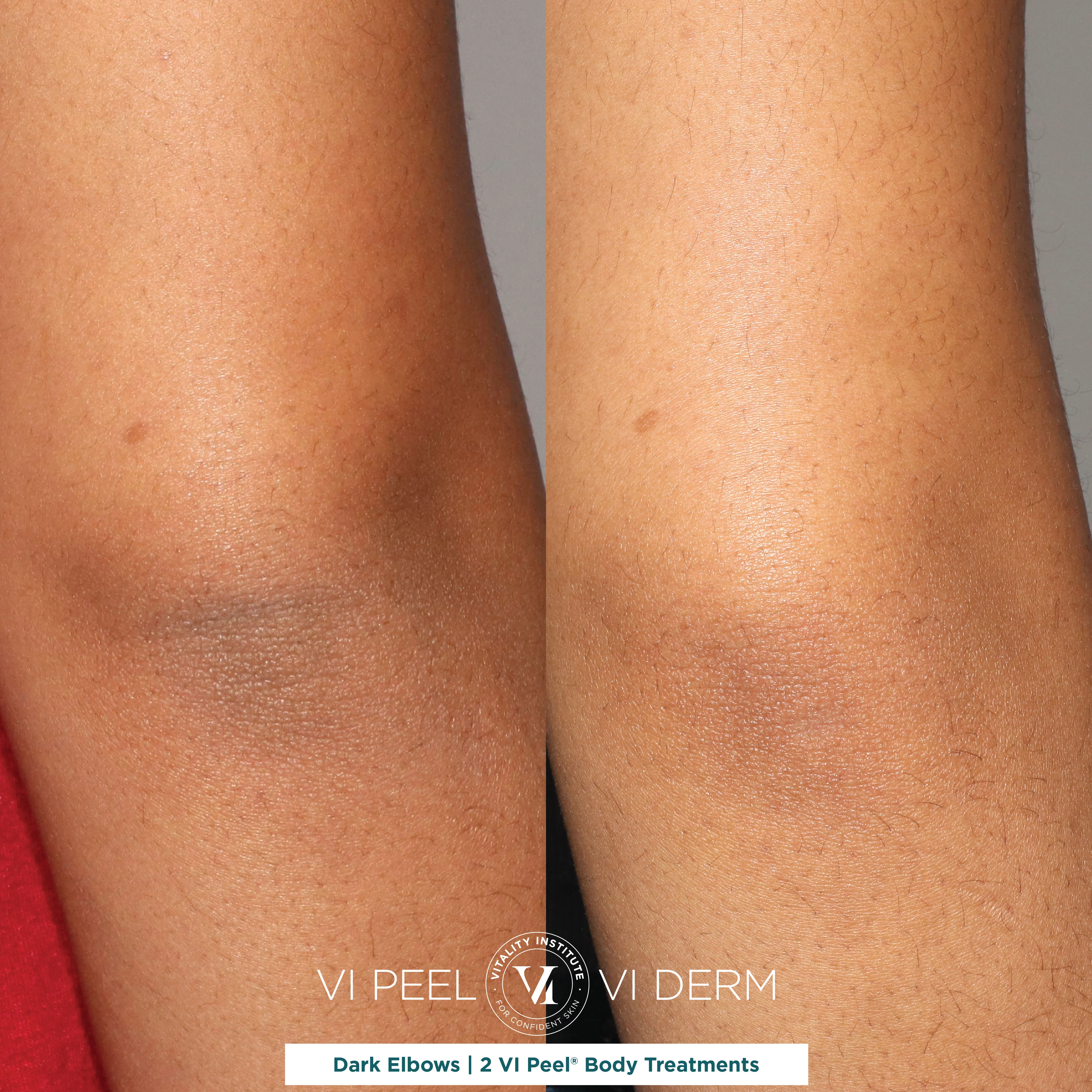 Dark Elbows — 2 VI Peel Body Treatments